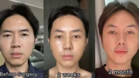 Transformasi Wajah Rafael Tan Usai Bedah Hidung Dan Perbaikan Mata