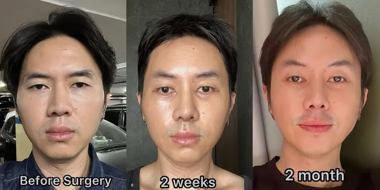 Transformasi Wajah Rafael Tan Usai Bedah Hidung Dan Perbaikan Mata