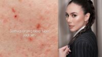 Wulan Guritno menunjukkan bekas jerawat di wajahnya Wulan Guritno Menunjukkan Bekas Jerawat Di Wajahnya